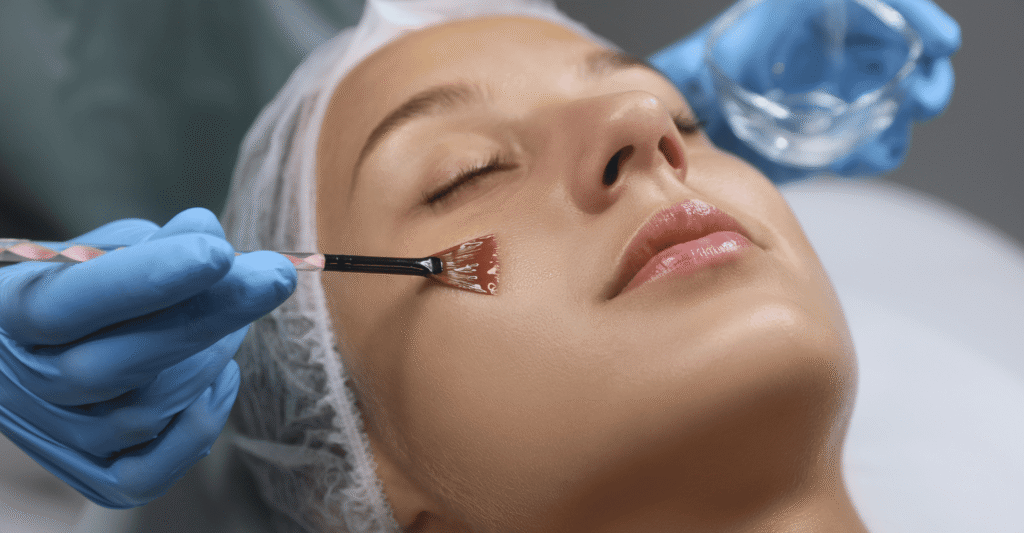 Chemical peel