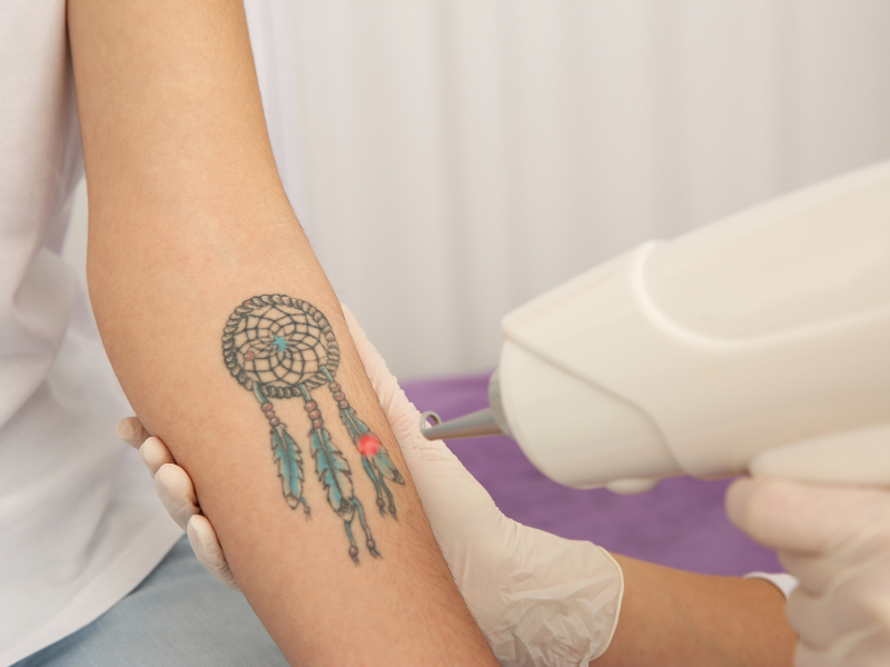 Coloured Tattoo Removal