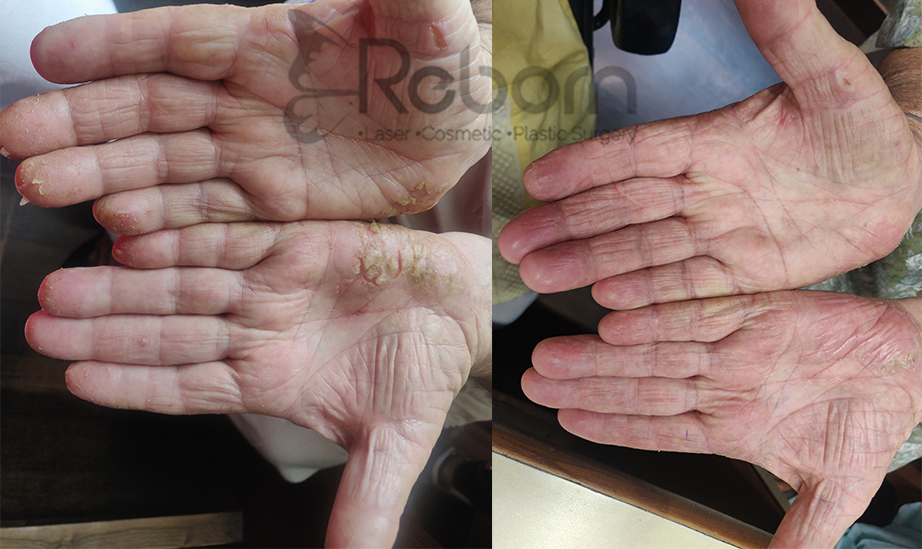 ECZEMA