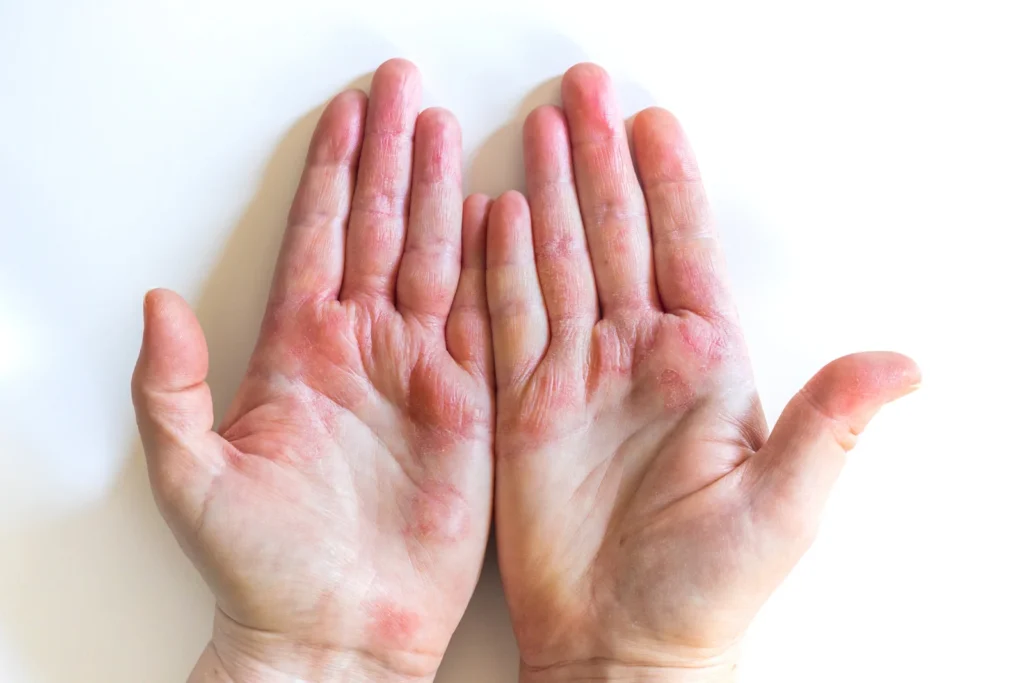 Eczema-Assessment