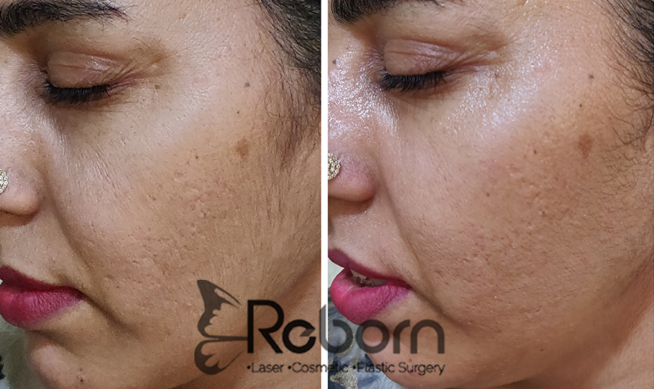 Hydrafacial