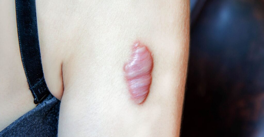 Keloid