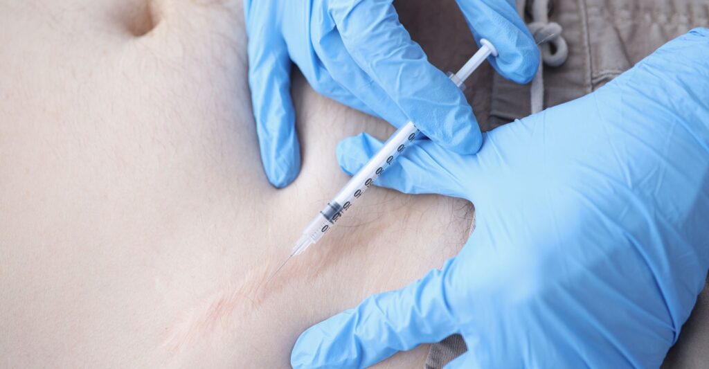 Keloid