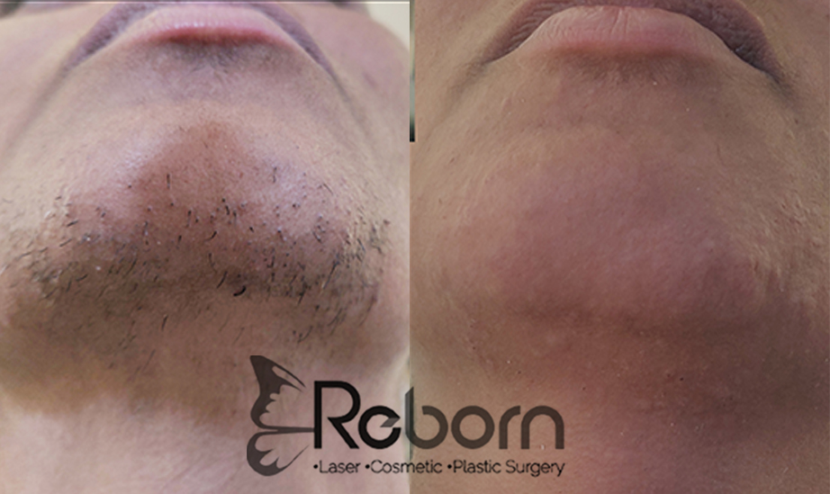 Laser Hair Reduction