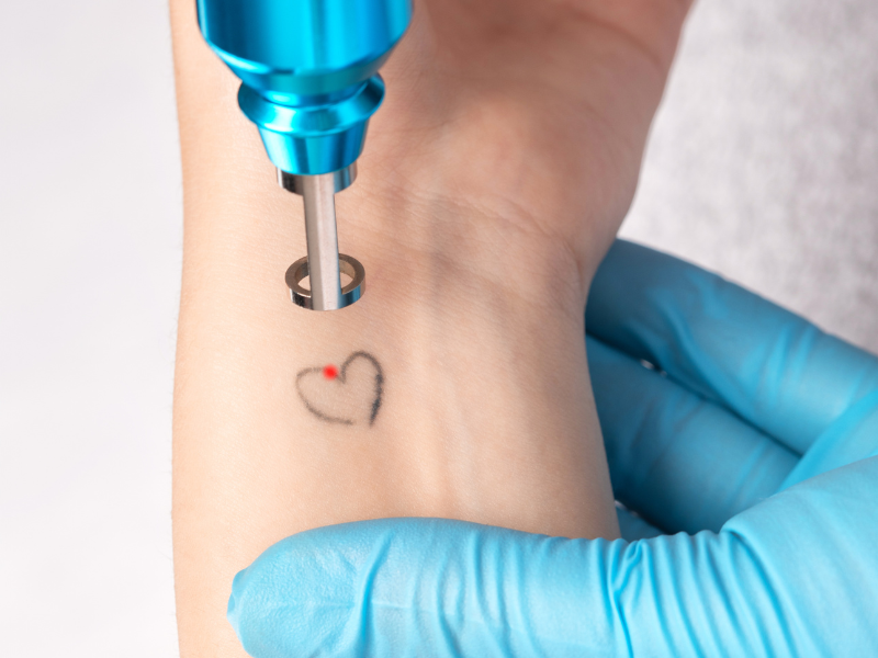 Laser Tattoo Removal