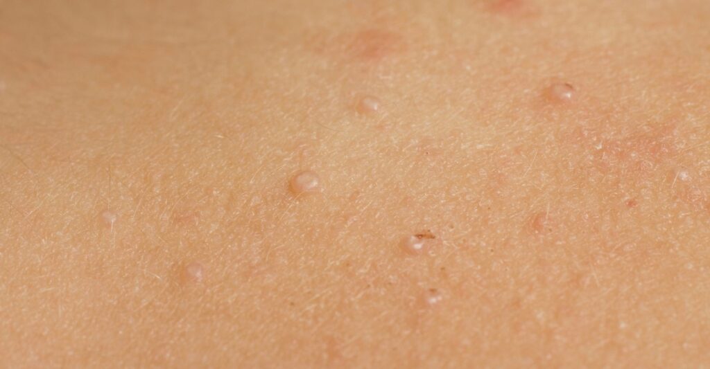 Molluscum Contagiosum