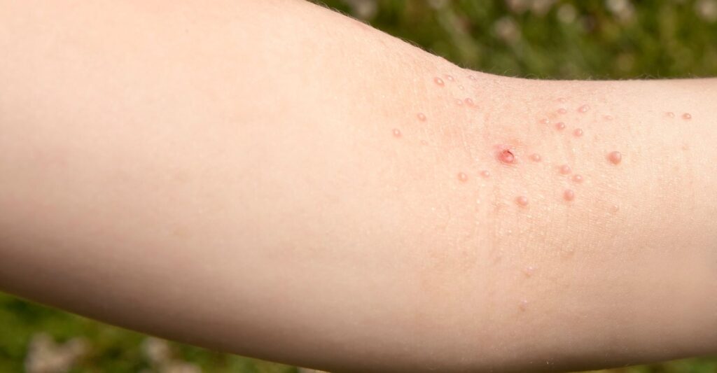 Molluscum Contagiosum