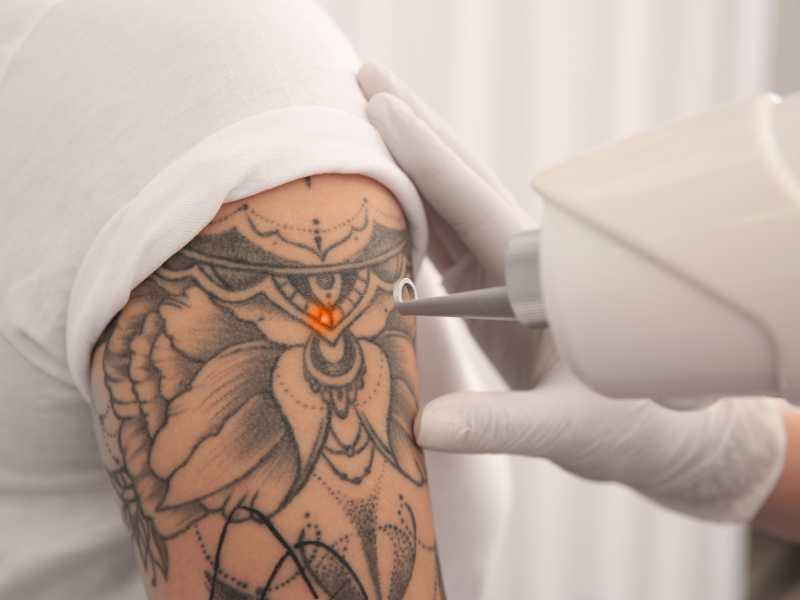 Partial or Complete Tattoo Removal