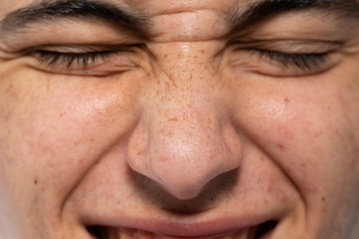 Pigmentation-&-Age-Spot--img