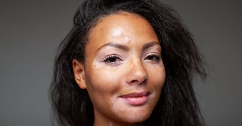 Vitiligo