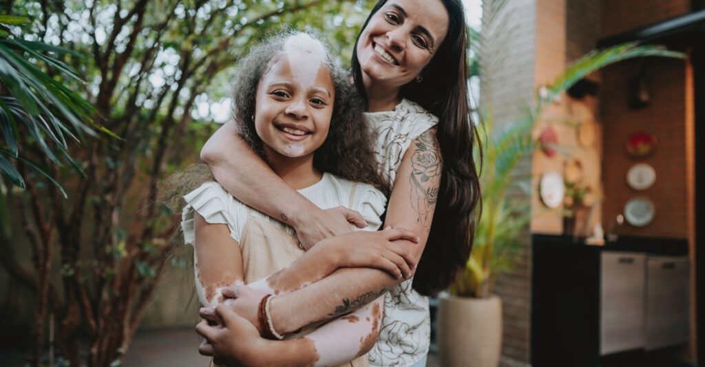Vitiligo