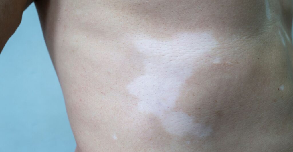 Vitiligo