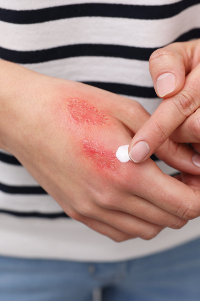 applying-ointment-on-burn-scar