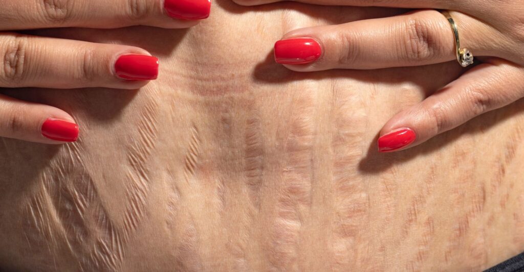 red stretch marks