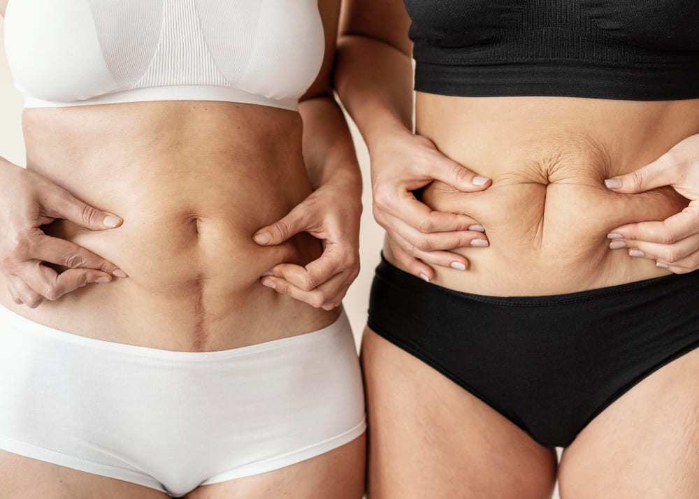 Tummy Tuck