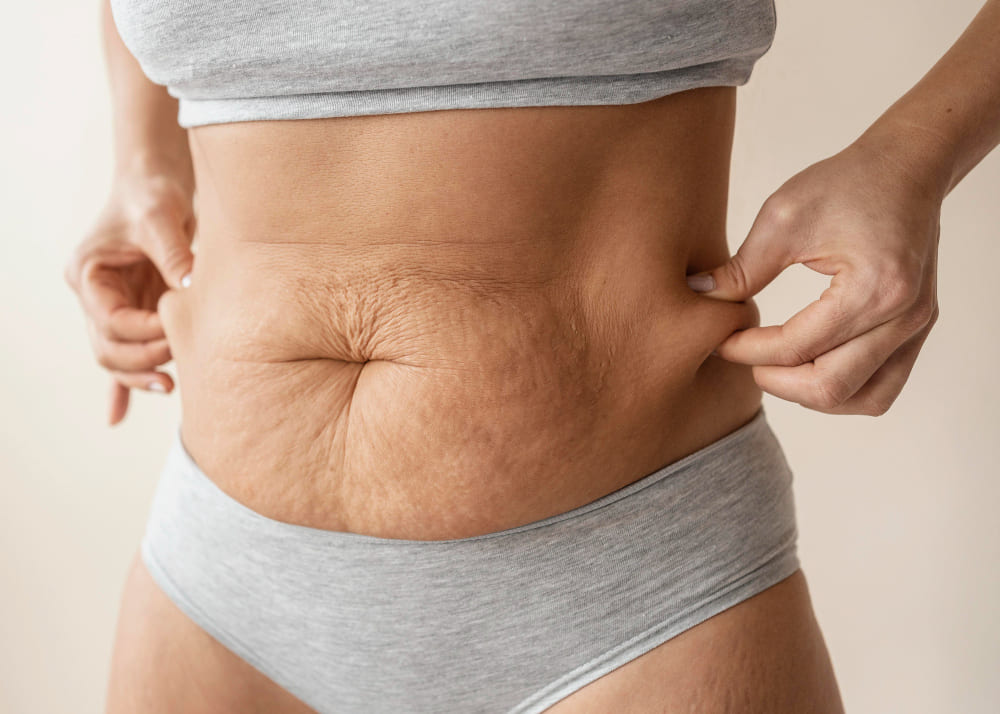 Tummy Tuck