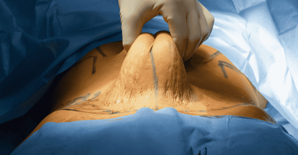 Abdominoplasty