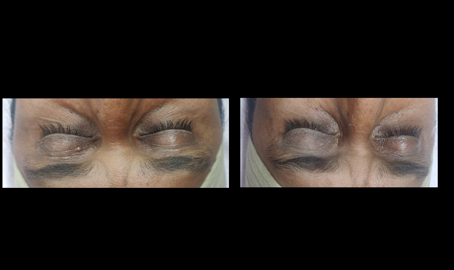 Eyelid milia removal