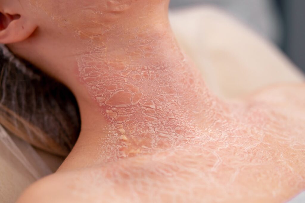 Hives-img-min