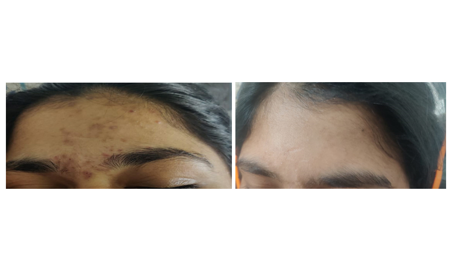 Pigmentation results
