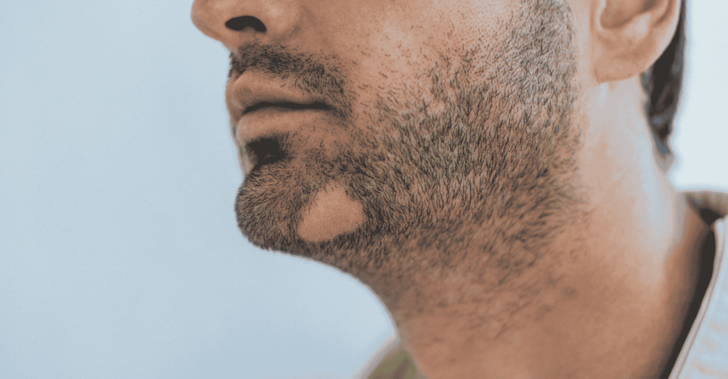 Beard transplant