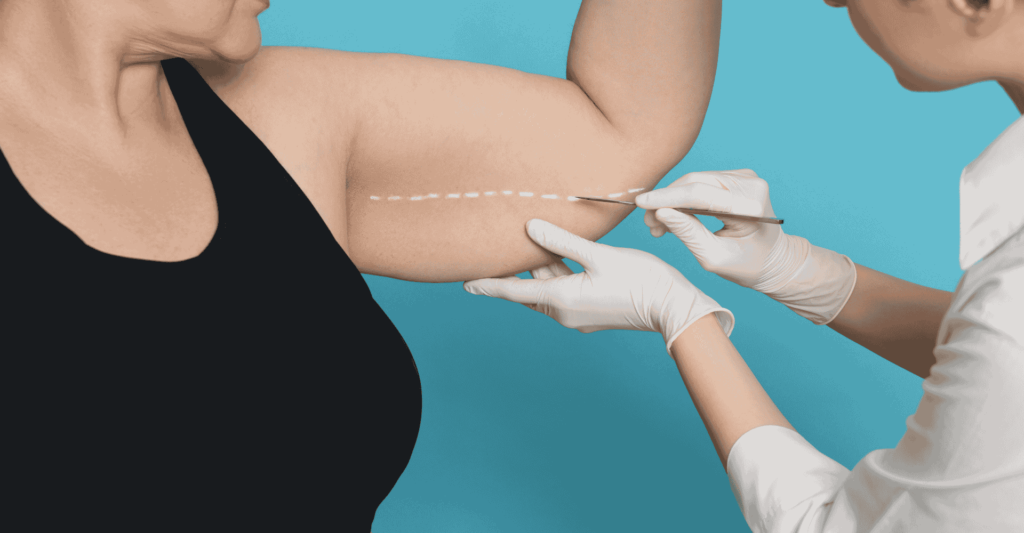 Arm liposuction