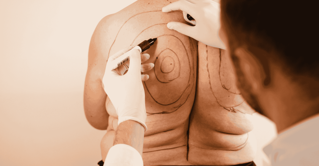back liposuction