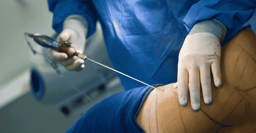 liposuction