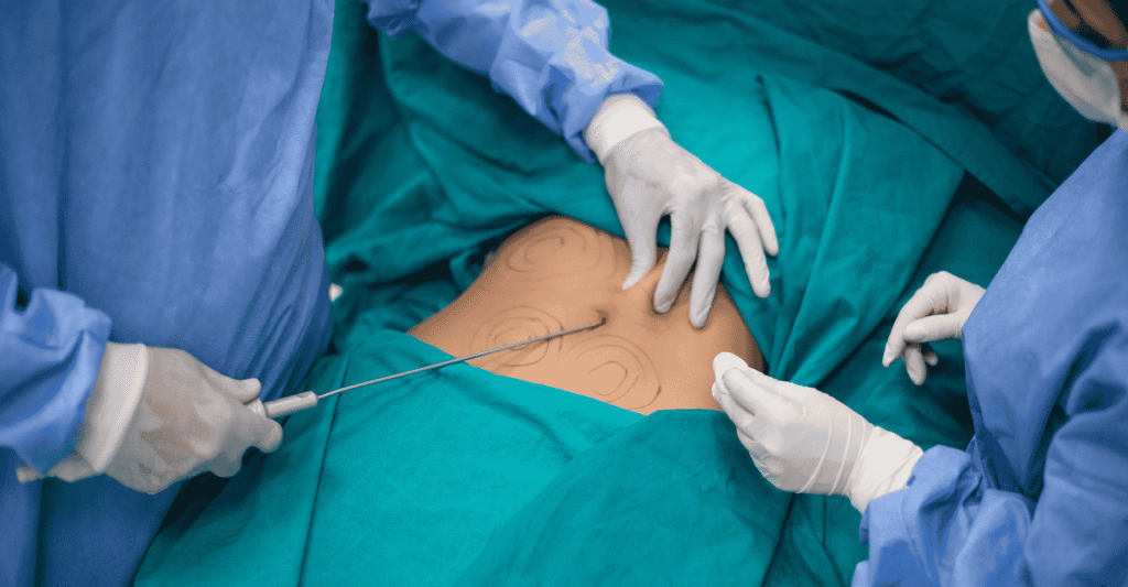 woman under liposuction surgery