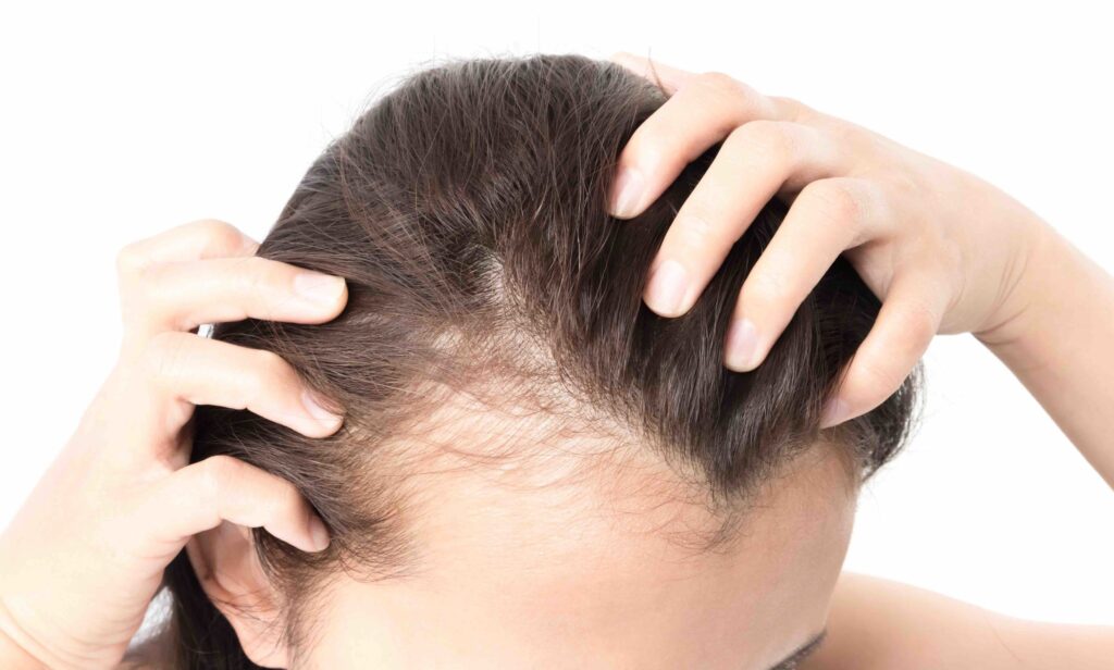 women-hair-loss