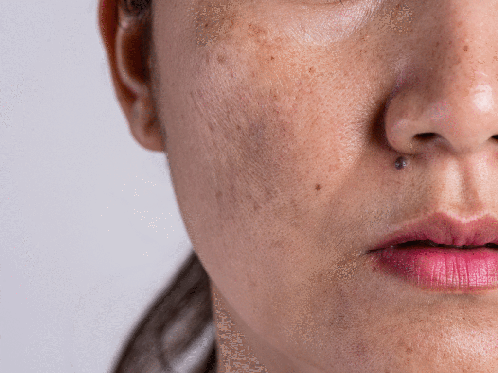 Melasma