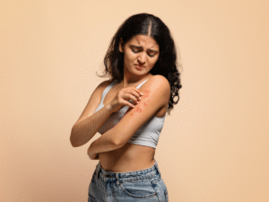 Eczema and Psoriasis