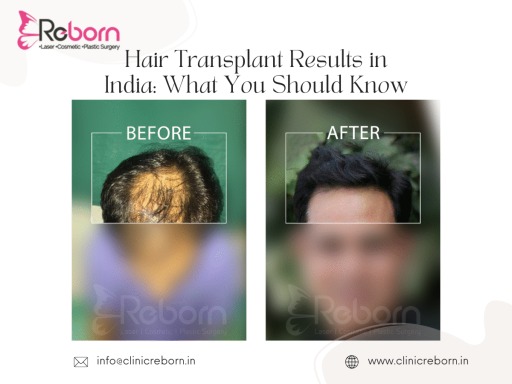 Before and after Hair transplant