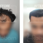 Hair Transplant: Before and After
