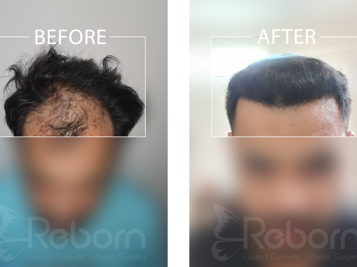 Hair Transplant: Before and After