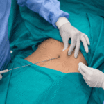 Woman having liposuction