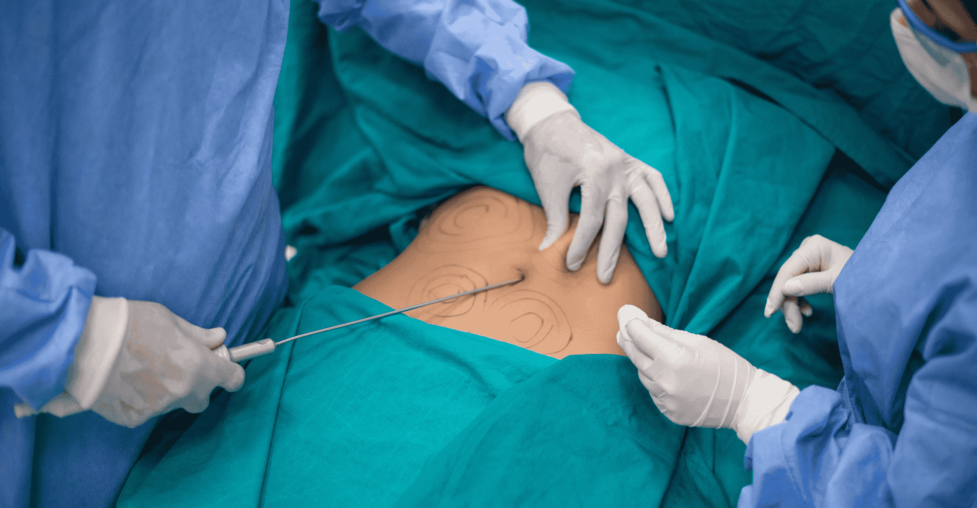 Woman having liposuction