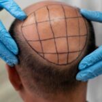 Hair Transplant