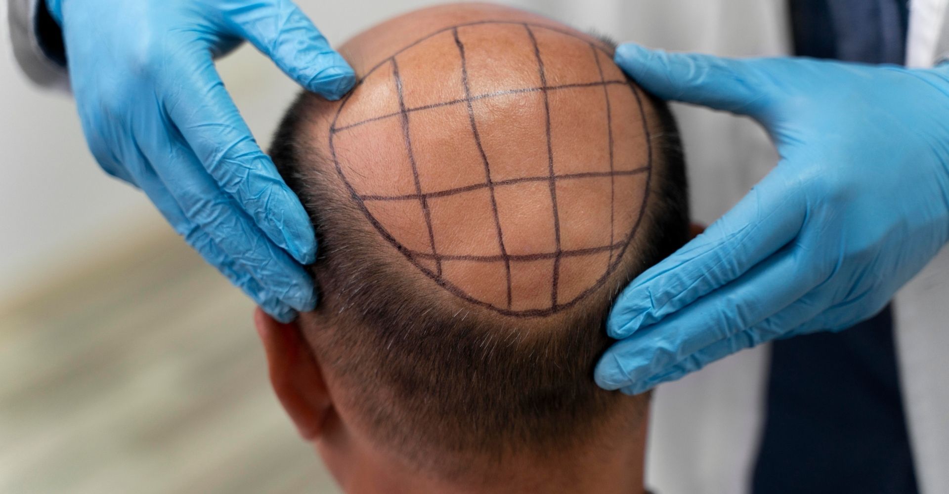 Hair Transplant