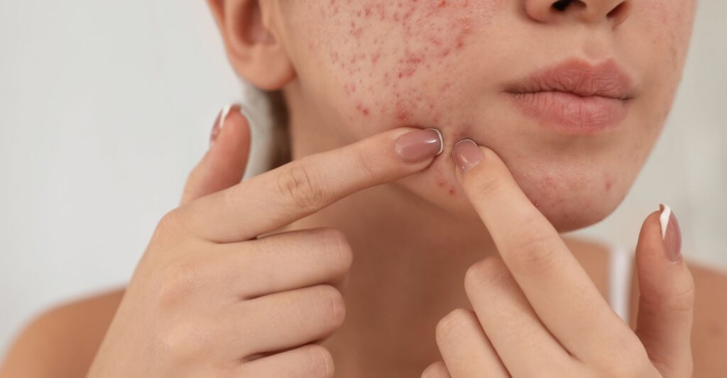 acne-treatment