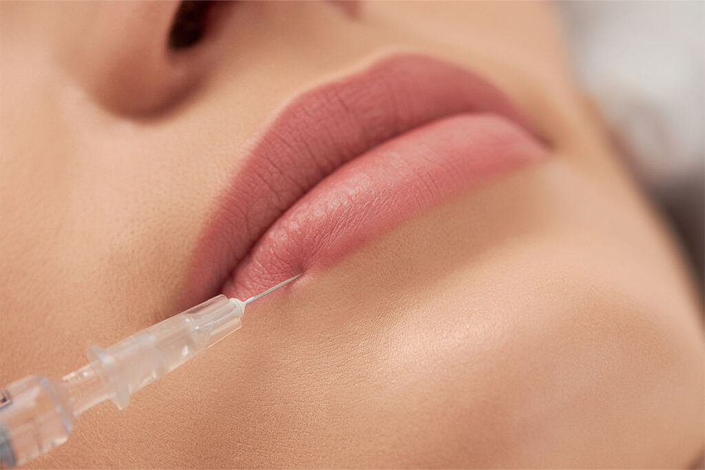 Lip-Fillers-_Img