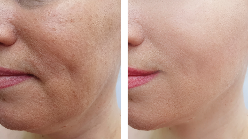 anti aging before after