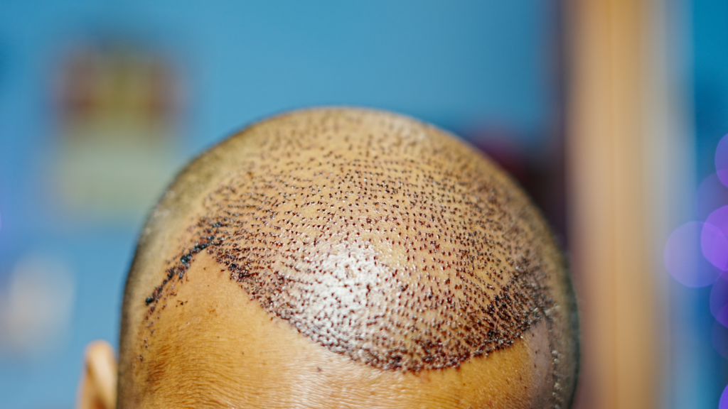 hair transplant at clinic reborn