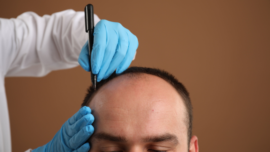 hair transplant zirakpur