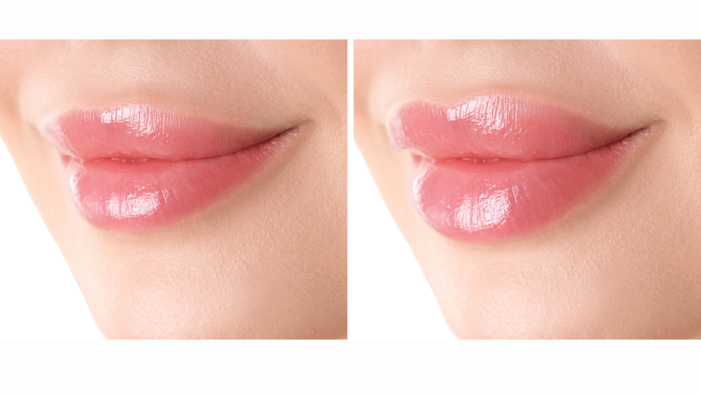 lip fillers zirakpur