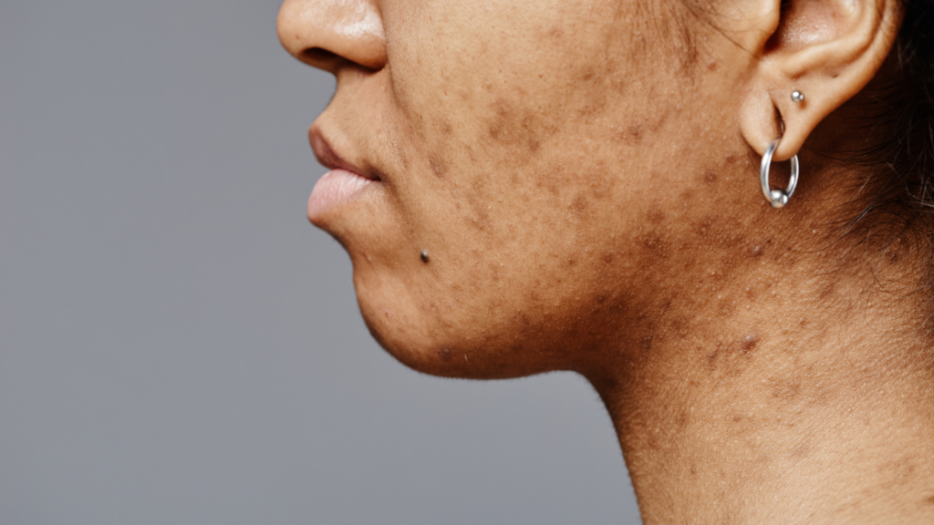pigmentation treatment zirakpur