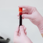 blood test for hairfall