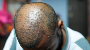 is hair transplant painful