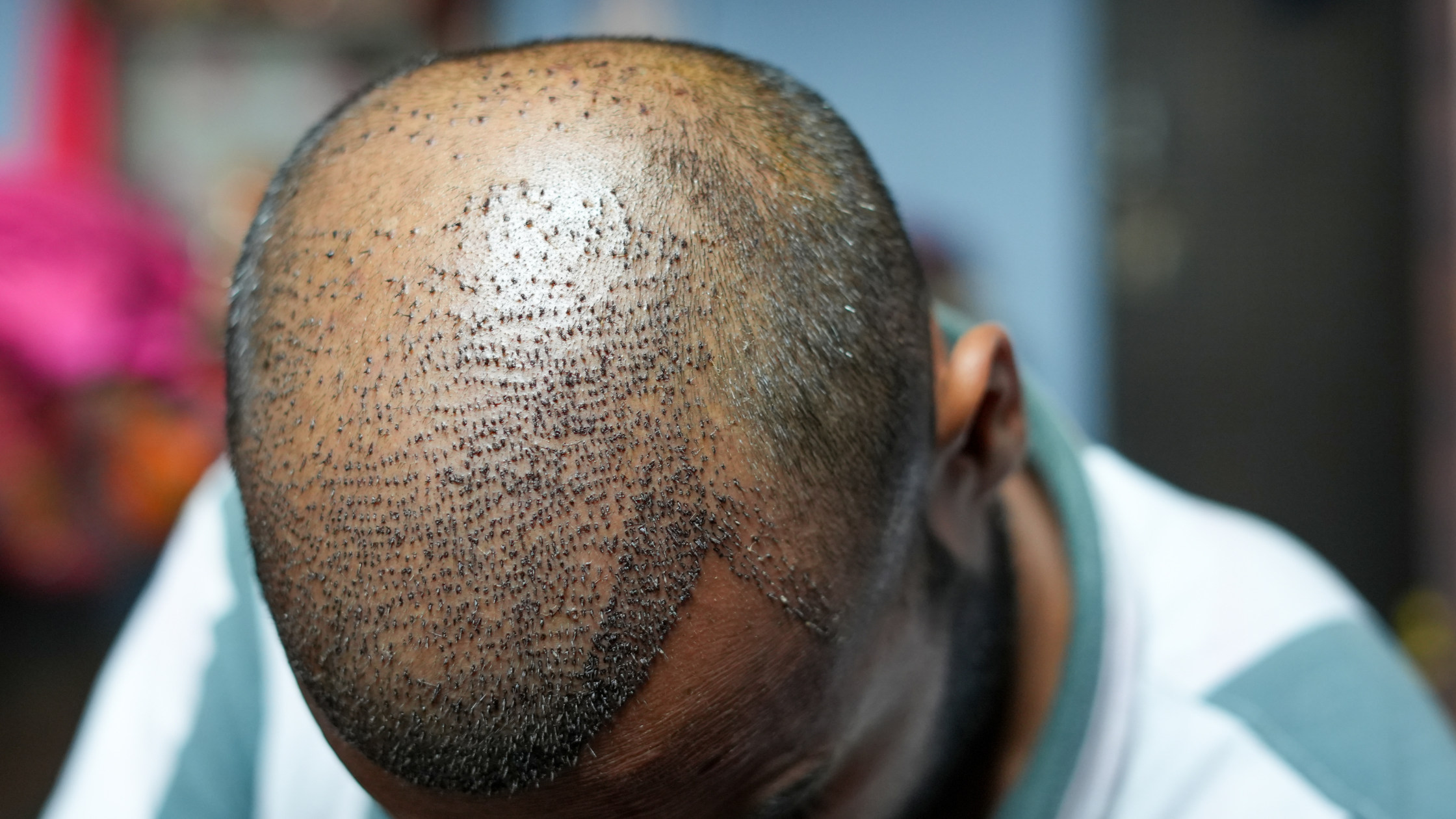 is hair transplant painful
