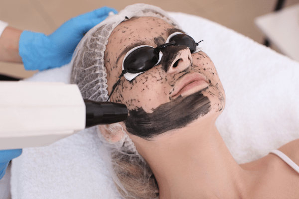 Carbon Peel